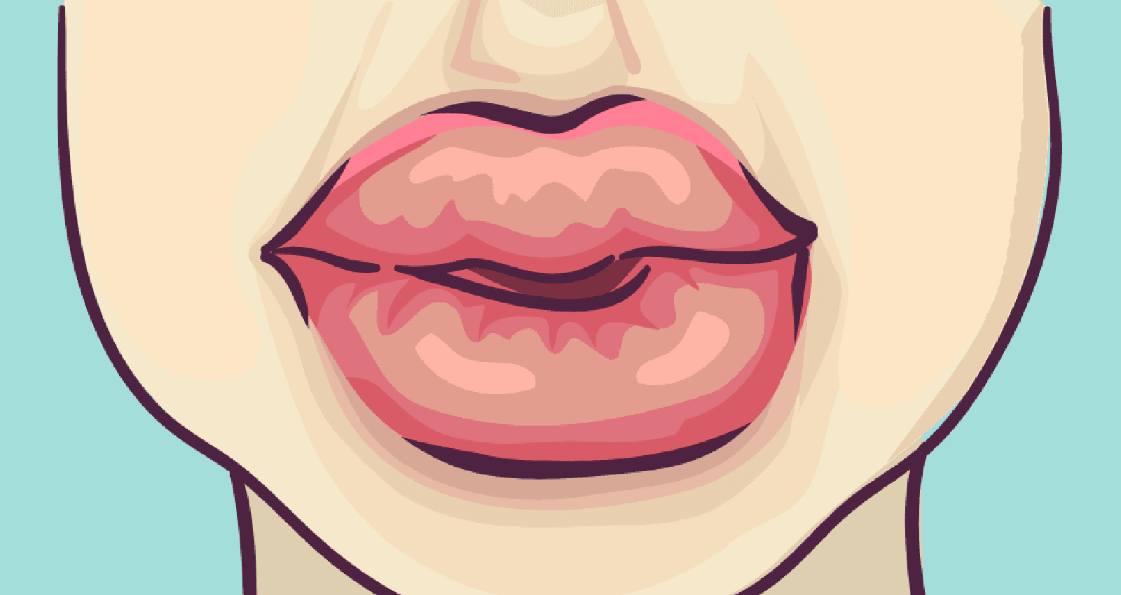 Why Is My Lip Line Swollen Lips Infoupdate