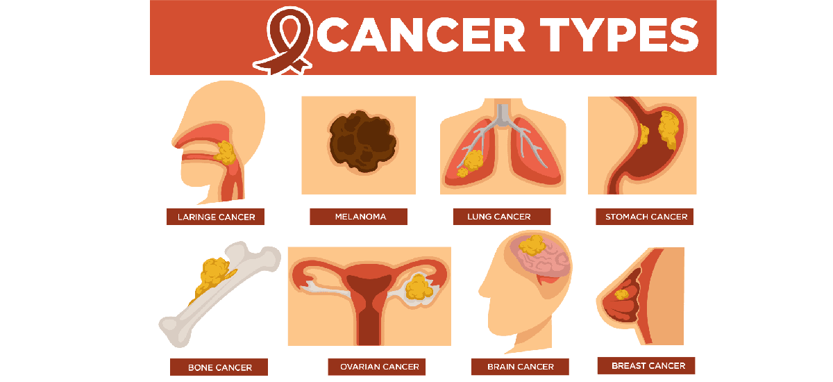 Common Types Of Cancers And Their Origins