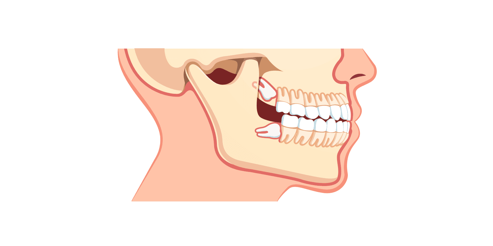 Wisdom Tooth In Upper Upper Wisdom Teeth Is Wisdom Tooth Extraction Always Necessary?